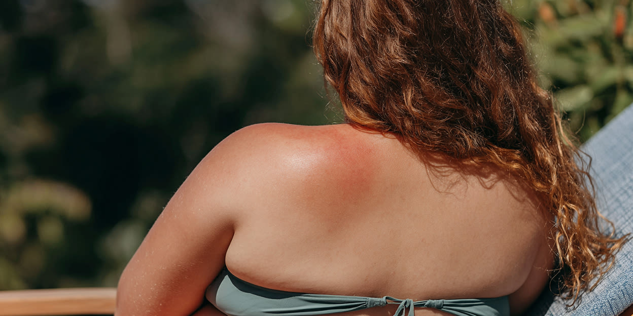 Kvinna med långt brunt lockigt hår iförd ljusgrön bikini sitter i grå solstol utomhus. Ena axeln har blivit röd av solbränna. Bilden är delvis skapad med AI.